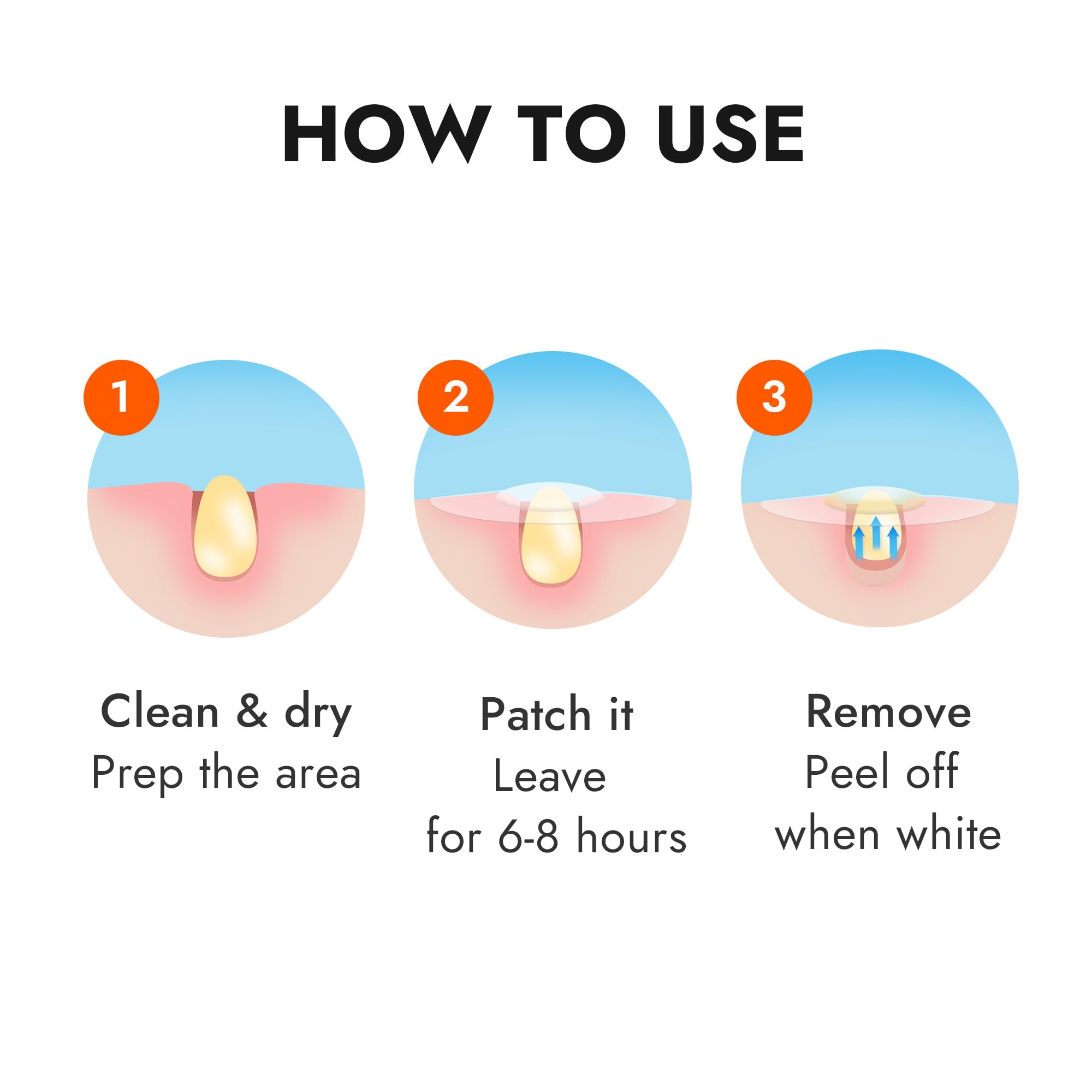 Epielle Over-Zit Acne Variety Patches | 84 Hydrocolloid Acne Pimple Patch for Covering Zits and Blemishes for Full Face (84 Count)
