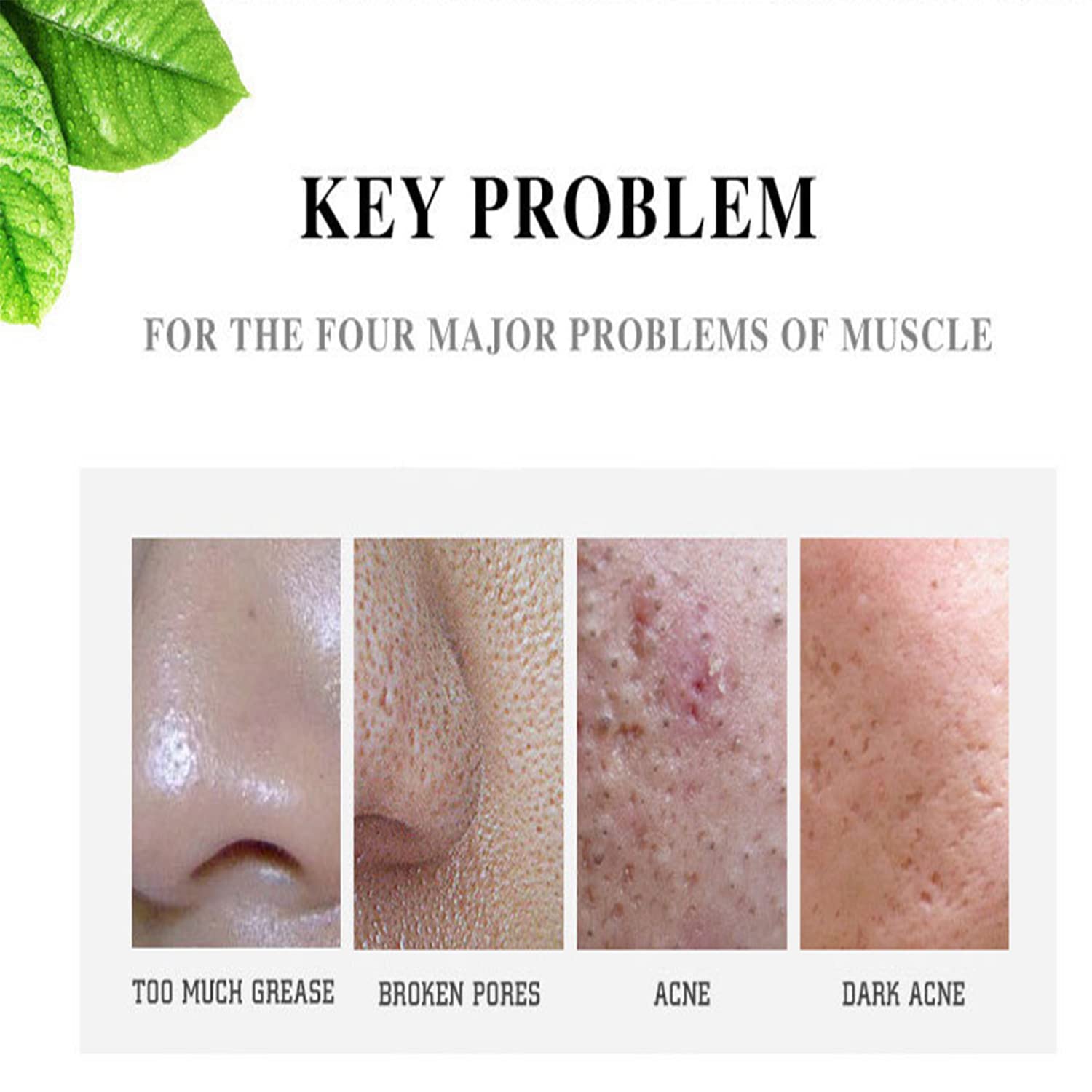 AICHUN BEAUTY Face Acne Cleaning Cream Skin Care Remove Repair Comedone Pimple Acne Face Acne Cream 30ml/1.0fl.oz