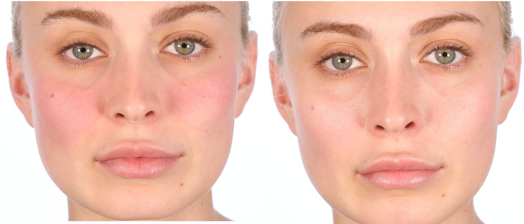 Nakery Intensive Repair Treatment Eczema Relief Soothing Cream for Face & Body | 2% Colloidal Oatmeal | Immediate Relief