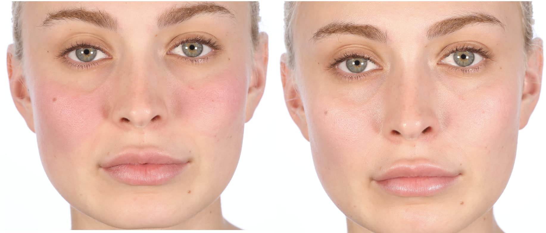 Nakery Intensive Repair Treatment Eczema Relief Soothing Cream for Face & Body | 2% Colloidal Oatmeal | Immediate Relief