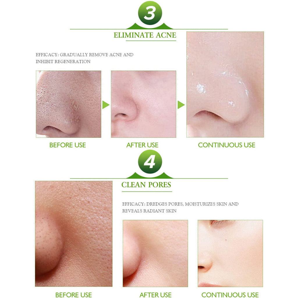 AICHUN BEAUTY Face Acne Cleaning Cream Skin Care Remove Repair Comedone Pimple Acne Face Acne Cream 30ml/1.0fl.oz