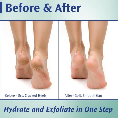 Pedifix Podiatrists' Choice 20% Urea Callus Control Extra Strength Foot Cream 4 Oz. (113g) - Professional Treatment for Dry, Cracked Feet, Callus & Foot Care Relief