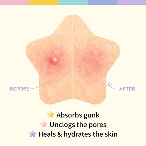 #OOTD Star Pimple Patches – Hydrocolloid Acne & Spot Patch for Face, Cute Pastel Colors, Niacinamide & Ceramide, K-Beauty Skincare – Stocking Stuffer for Teen Girls – 80 Count