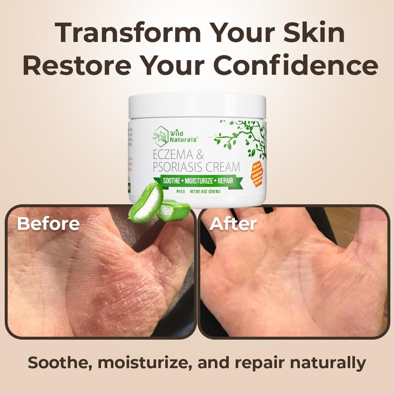 Wild Naturals Eczema & Psoriasis Cream - Moisturizing Relief for Dry, Itchy Skin | Manuka Honey Formula