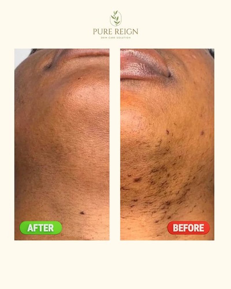 Pure Reign Skin Care Solution | Ingrown Hairs, Razor Bumps, Shaving/Waxing 5oz (150ml)