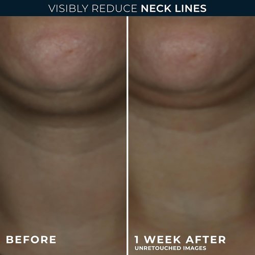 RoC Derm Correxion Neck Cream - Hyaluronic Acid & Advanced Retinol for Tightening & Lifting (1.7 oz)