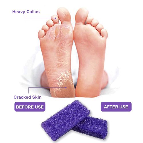 BPrettier Foot Pumice Stone Pumice Stone for Feet Foot Scrubber Sponge Callus Remover Dead Skin,Pedicure Supplies Nail Salon Home Use 40 PCS