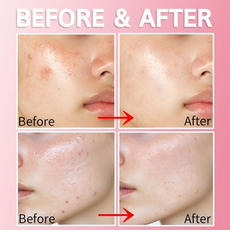 Purederm Blemish Spot Treatment Gel - Salicylic Acid 2% for Soothing Acne Care | 20ml