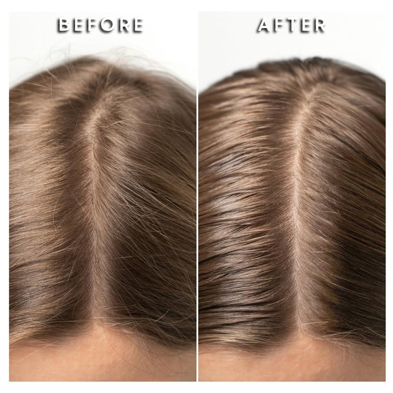 Vitamin Infused Scalp Serum - Hair Regrowth, Reduces Hair Loss, Soothes & Hydrates Dry Scalp, AMAZING Post Hair Transplant Scalp Treatment – Safe for All Hair Types