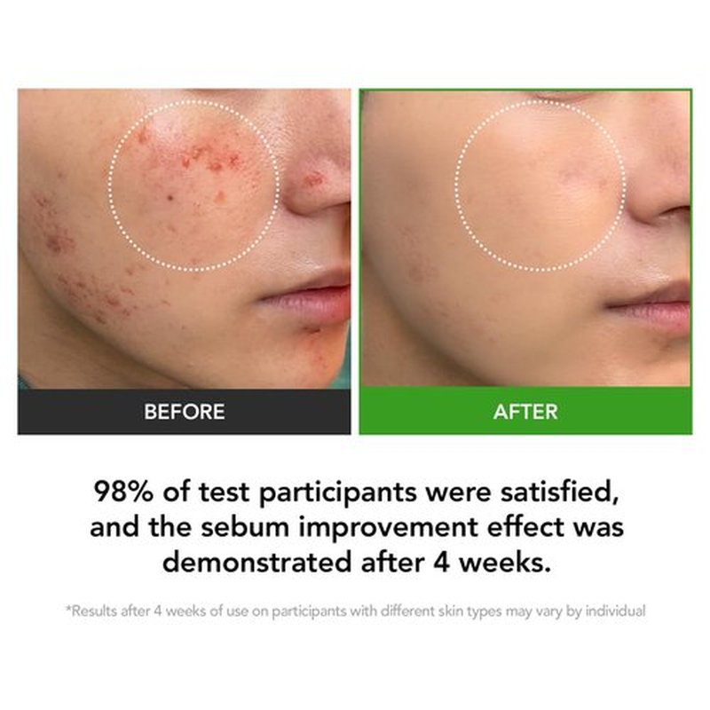 KIOSKIN 31% Reduction in Sebum & 15.5% High-Dose D-Panthenol | Calms Redness, Repairs Skin Barrier & Locks in Hydration | With Heartleaf Extract | Korean Skincare Daily Moisturizer (35 ml/1.18 fl.oz.)