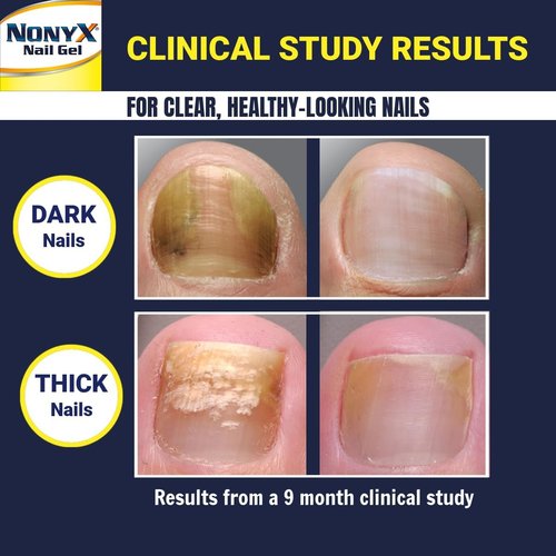 NONYX Fungal Nail Clarifying Gel - Clinically Proven Treatment for Discolored & Brittle Toenails | 90% Improvement Rate