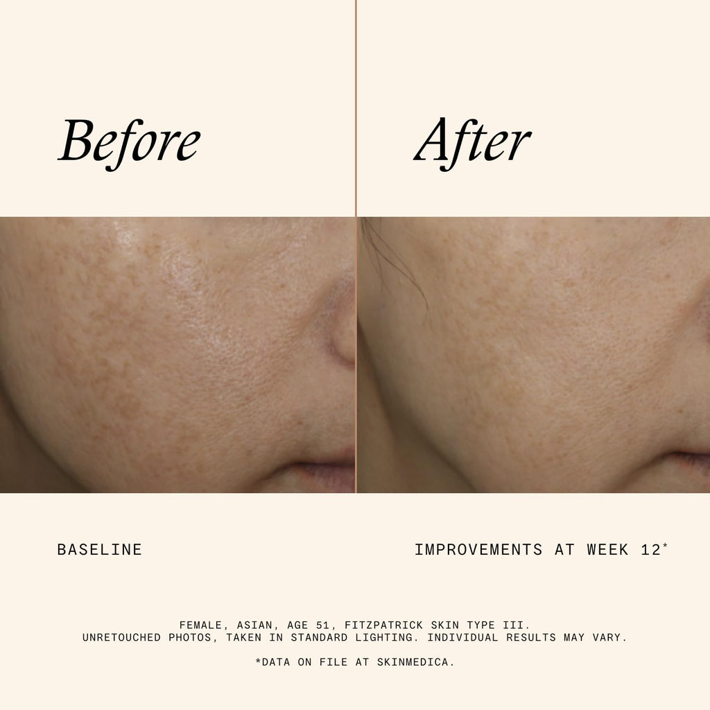 SkinMedica Even & Correct Advanced Brightening Treatment Face Serum (NEW PACKAGING), Addresses the Appearance of Dark Spots, Hyperpigmentation & Melasma for Aging Skin,1.7 Fl Oz