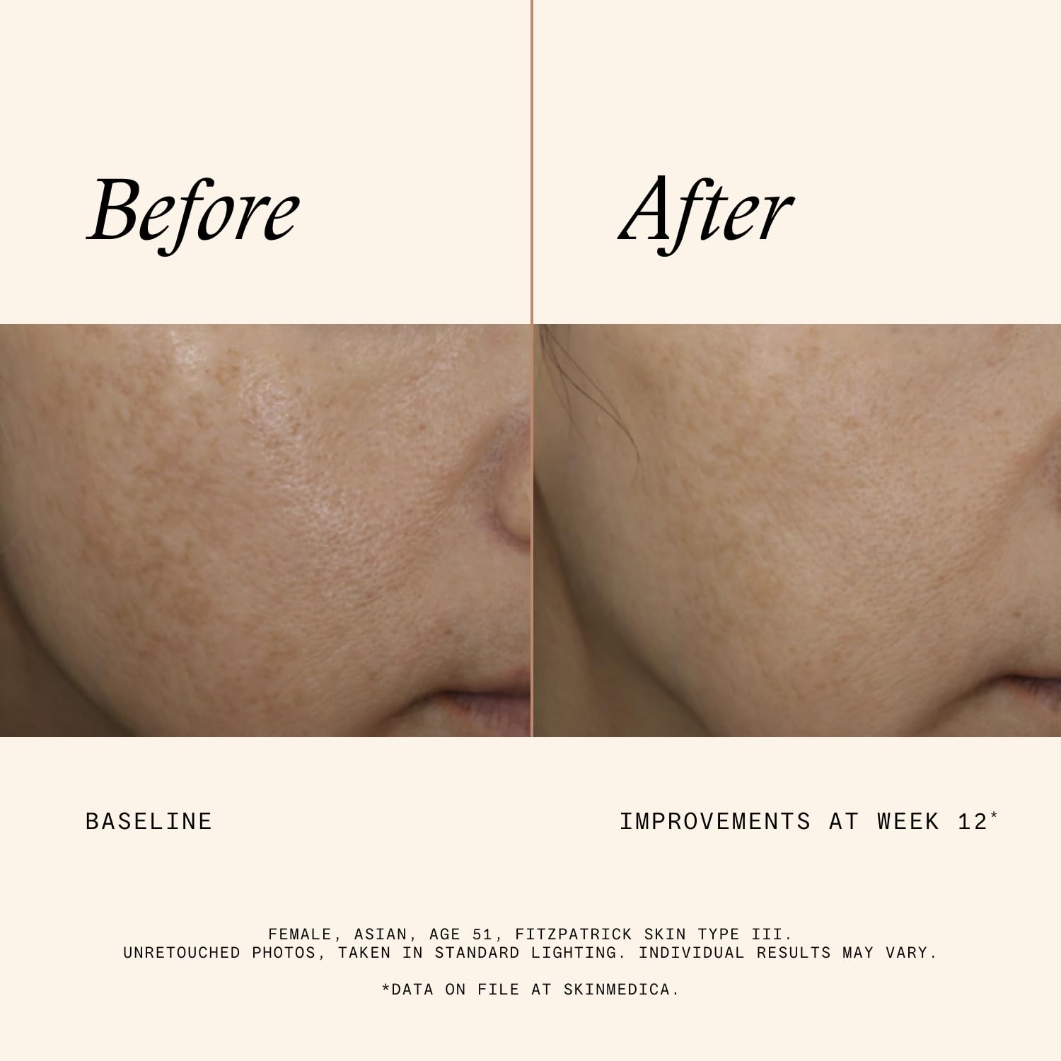 SkinMedica Even & Correct Advanced Brightening Treatment Face Serum (NEW PACKAGING), Addresses the Appearance of Dark Spots, Hyperpigmentation & Melasma for Aging Skin,1.7 Fl Oz