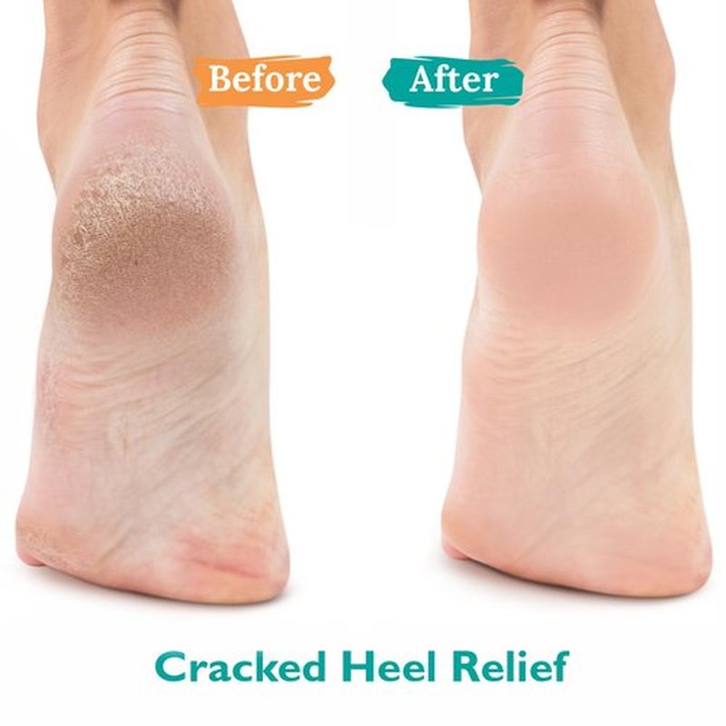 GILDEN TREE Urea Gel 42% - Maximum Strength Treatment for Softening Cracked Heels & Thick Toenails