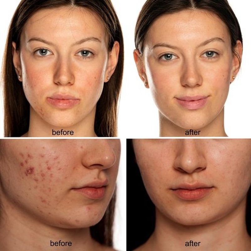 Avorla Beauty LED Mask - Multi-Wavelength Light Therapy for Wrinkles & Acne - Rechargeable for Home & Travel
