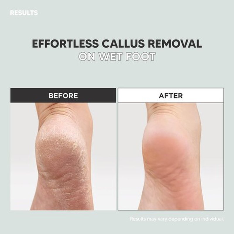 F3 Systems, Stainless Steel Callus Remover(Sky Blue), Effective for Thick Callus and Cracked Feet Pedicure Rasp, Remove Hard Skin, Grater Foot File, Foot Scrubber, Professional Foot Care