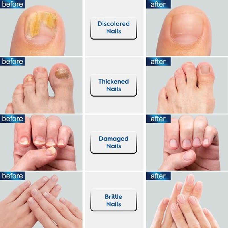 OSIMOON Toenail Fungus Treatment Extra Strength: Nail Fungus Treatment with 10% Undecylenic Acid, Nail Repair for Damaged Nails, Nail Fungus Treatment for Men and Women (2 Packs), Blue