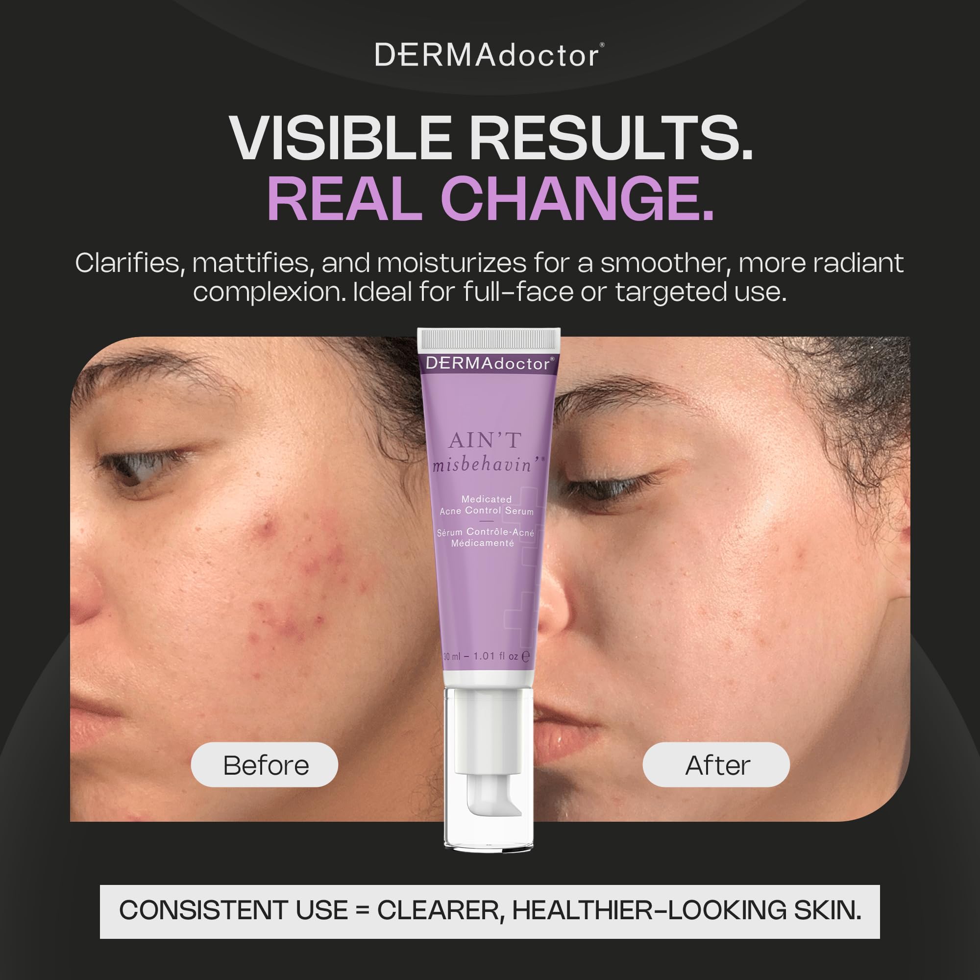 DERMAdoctor Ain't Misbehavin' Dermatologist Formulated Salicylic Acid Acne Control Serum, Acne Spot Treatment for Blemish Control and Cystic Acne breakouts with Tea Tree - 1 oz