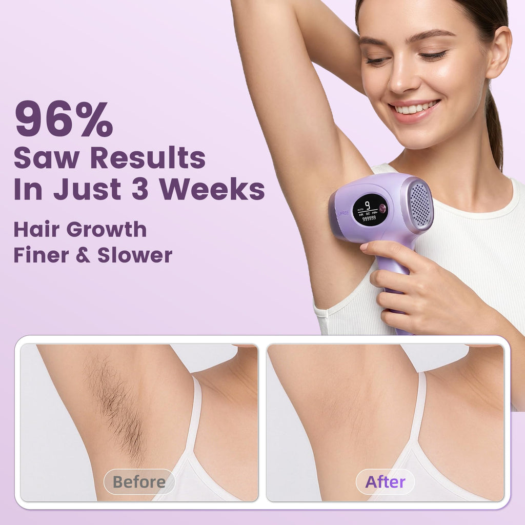 Ufree IPL Hair Removal Device, Full Body for Women Men at Home, Long-Lasting & Painless, 20J & 3 Smart Modes, 990k Flashes, Hair Remover for Armpits Legs Arms Face Bikini Line (Purple)