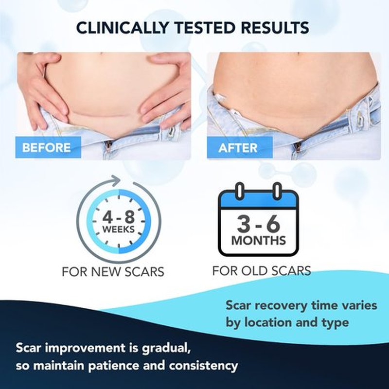 Silicone Scar Gel: Silicone Gel for Scars - Improve Scar Appearance for Old and New Scars - Medical Grade Silicone - Advanced Scar Gel - Scalds - Surgery - Injury - Stitches - Burns - 20g