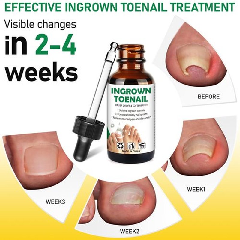 Ingrown Toenail Treatment: Ingrown Toenail Removal Kit - Ingrown Toenail Tool for Men Women - Ingrown Toenail Corrector Drops - Ingrown Toenail Remover - Effective Solution for Ingrown Toenails - 30ml