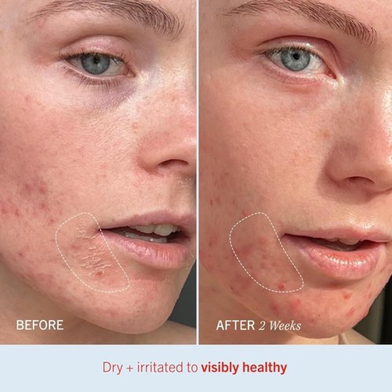 First Aid Beauty - Ultra Repair Cream | Intense Hydration with Whipped Colloidal Oatmeal, 14oz Fresh Strawberry