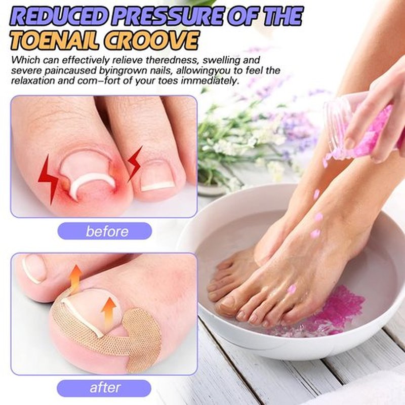 Ingrown Toenail Removal Kit, Ingrown Toenail Tool with Ingrown Toenail Strips, Curved Toenails Corrector Patch, Painless File and Lifter, Ingrown Nail Correction Home Care for Men and Women.