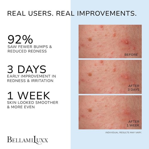 BellamiLuxx Folliculitis Acne Lotion - Soothes Itch & Redness, Reduces Body Acne & Bumps | Gentle Formula with Salicylic & Glycolic Acid