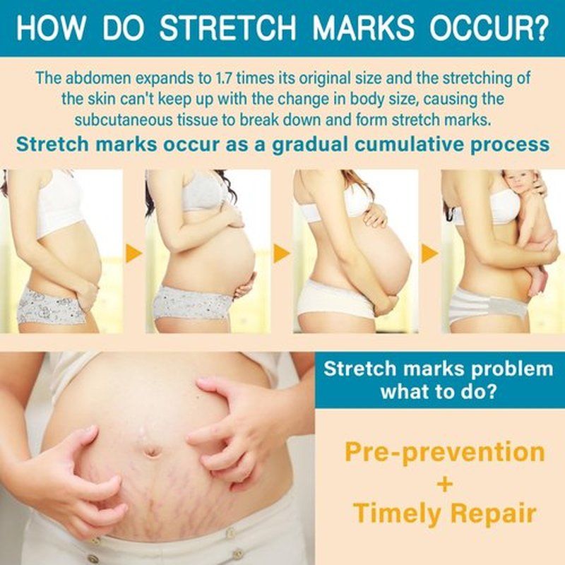 PEGO Stretch Mark Butter - Maternity Cream for Reducing Scars & Moisturizing Skin | 100g/3.53oz