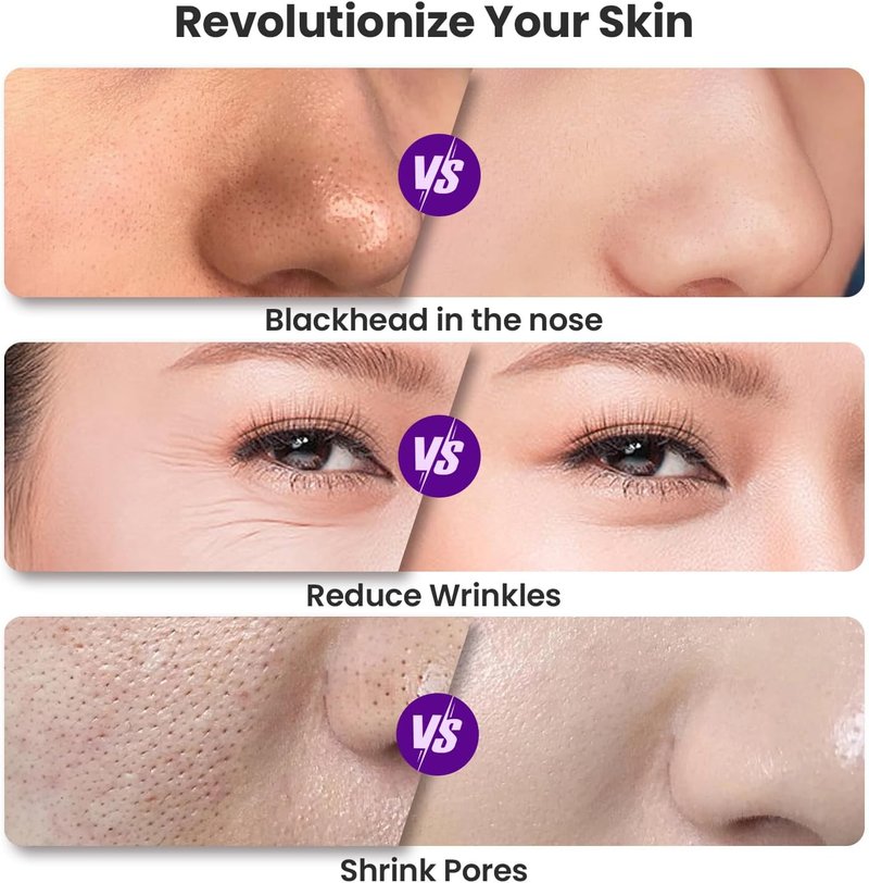 UNOISETION Diamond Microdermabrasion Machine - Rechargeable Facial Tool with 12 Tips | Blackhead Remover for Home & Travel