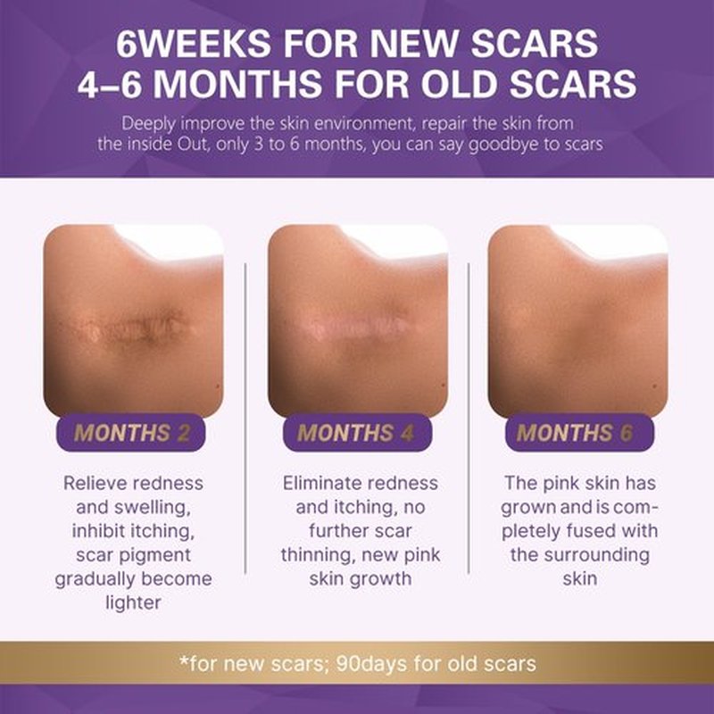 Scar Soothing Cream,Scar Cream,Advanced Scar Removal Cream for Surgical Scars, 3% Dimethicone Complex Silicone scar cream for Old & New Scars,C-Section, Pregnancy, Acne, Injury, Keloids, Burns (1PCS)