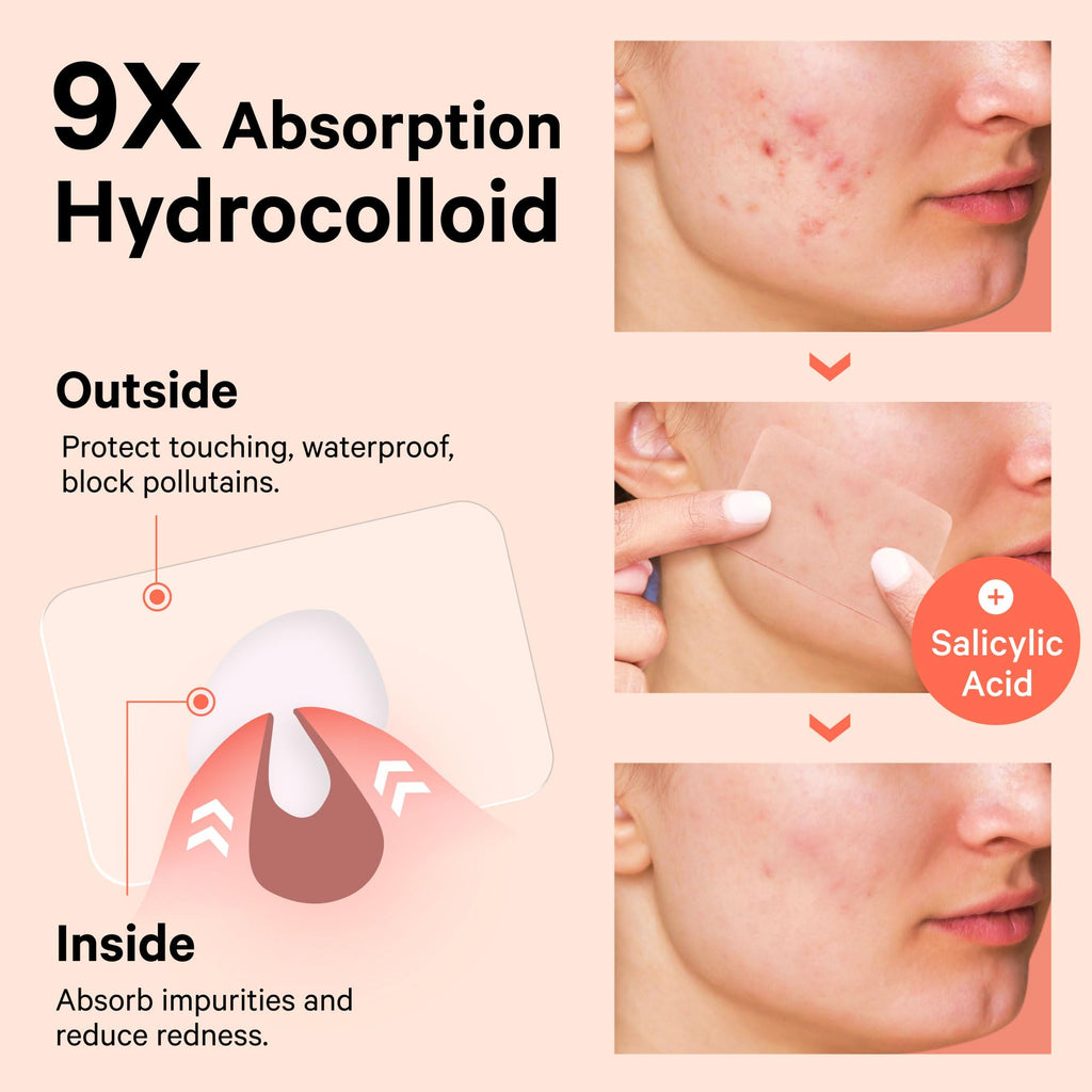 Sosky Large Pimple Patches XL Hydrocolloid Acne Patches for Face & Body Cystic Pimple & Zit Patch for Nose Chin Back, Bacne & Breakouts Vegan Cruelty-Free（10 Count）