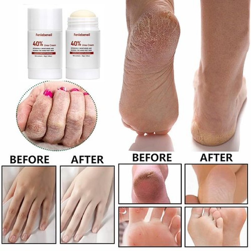 fenlebeneil 40% Urea Cream Cracked Heel Balm for Dry, Cracked Feet, Heals, Foot Hand Moisturizing 40 Percent Foot Urea Cream for Feet Maximum Strength 2Pack