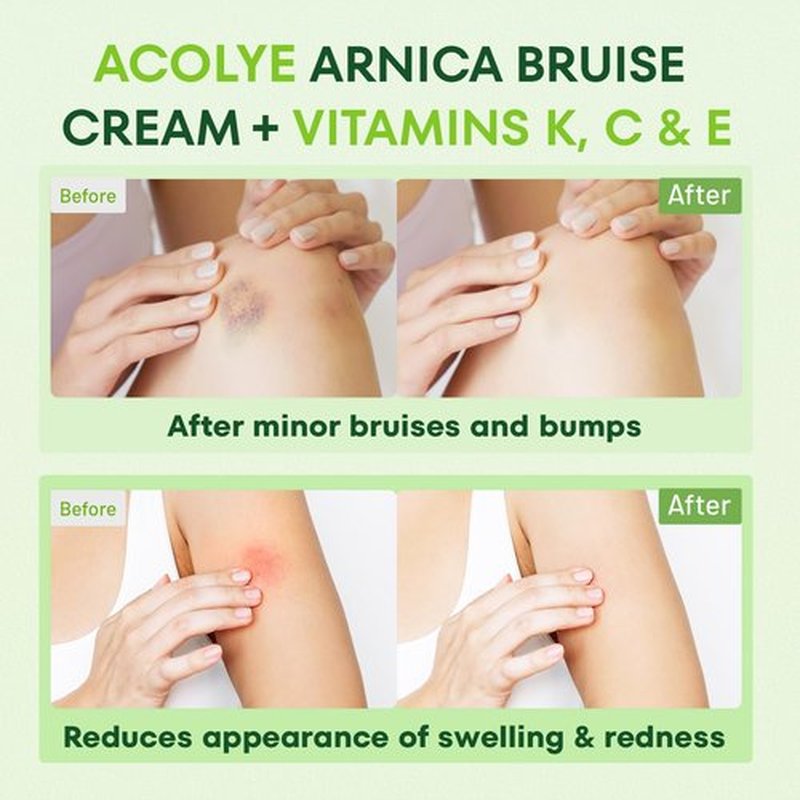 Acolye Arnica Cream for Bruising and Swelling: Extra Strength Arnica Bruise Cream with Vitamins K C E for Seniors Aged 55 and Above - Fast Healing Formula Ideal for Thin Skin 3.5 oz
