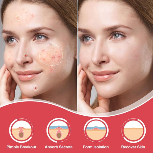 216 Counts Pimple Patches for Face, Hydrocolloid Acne Patches Zit Patches for Face Acne Spot Treatment Patch Cystic Acne Treatment Stickers Blemish Hydrocolloid Cover for all Skin Type