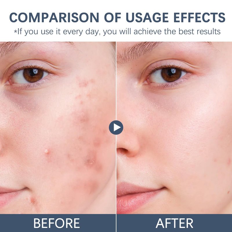 2pcs Acne & Redness Killer, Organics Acne Balm, Remove Skin Care Set Natural Plant Formula For All Skin Types