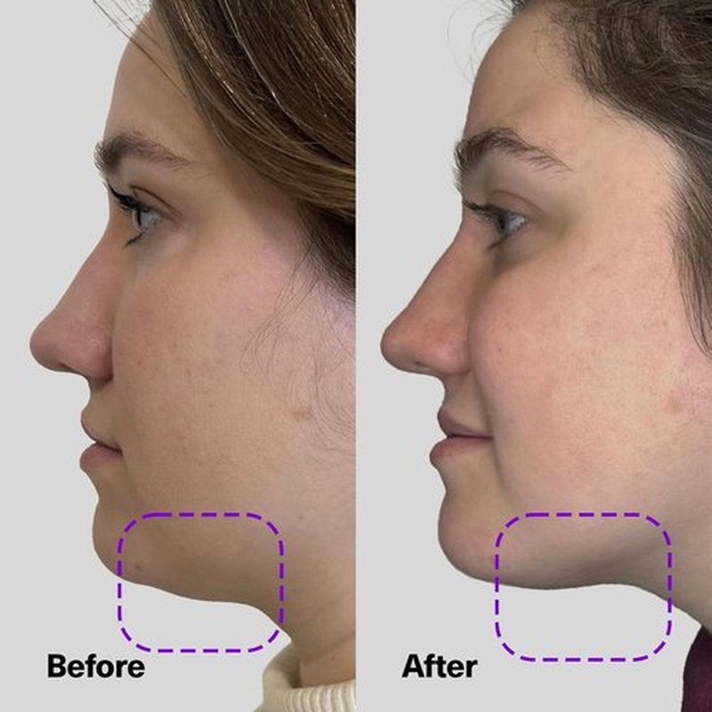 SickScience ShapeShift Jaw & Neck Firming Serum - Double Chin Reducer & Face Tightening Treatment, 1.7oz