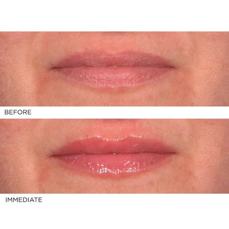 NassifMD Hydro-Screen Lip Plumping Oil - Hydrating Serum with Hyaluronic Acid & Ceramide Jojoba Gloss