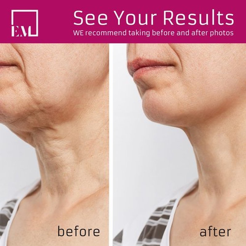 EpidermOpt Anti Aging Firming Neck Cream: Lifting & Tightening Moisturizer for Skin Repair – Reduces Lines, Crepey Skin & Uneven Tone – Perfect Skincare Gift for Mom or Skincare Bonding Together