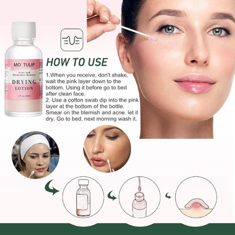 MO TULIP Acne Drying Lotion - Overnight Spot Treatment for Face & Body | 1 OZ Pimple Solution