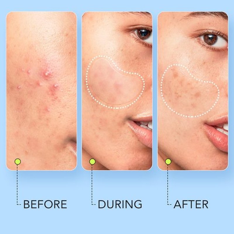LitBear Large Pimple Patches (7 Sizes 112 Counts), Big Acne Patches, XL Hydrocolloid Bandages for Full Face, Forehead, Chin, Nose, Body, Back, Neck & Chest, Oval, Moon, Square hydrocolloid Patch
