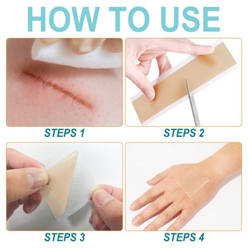 Silicone Scar Sheets (1.6” x 150”-3.8M), Medical Grade Soft Silicone Scar Tape, Scar Strips, Scar Roll - Keloid, C-Section, Surgical, Acne- Scars Removal Treatment, Painless Easy Removal, Reusable
