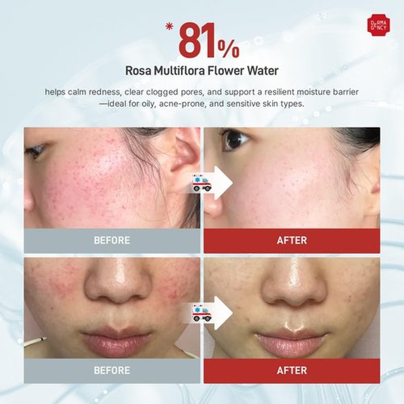 DERMAGENCY Zeroca 81 Serum – Korean Wild Rose Serum for Acne-Prone & Sensitive Skin – Balances Oil-Water, Soothes Redness, Fades Post-Blemish Marks, Firms & Hydrates 1.01 oz. 30 ml