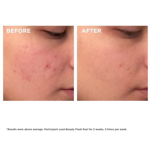 Clarins Beauty Flash Peel - 10-Minute At-Home Facial for Pore Tightening & Skin Renewal | All Skin Types