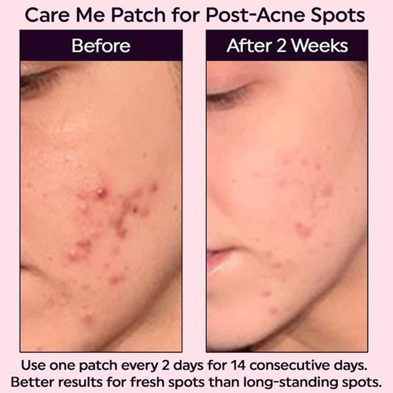 Care Me Microdart Dark Spot Patch - 127 Micropoints for Fading Acne Marks & Dark Spots | 9 Patches