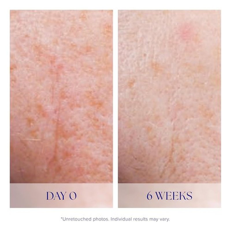 iS CLINICAL Active Serum - Visibly Evens Skin Tone | Anti-Aging Face Serum for Acne-Prone Skin