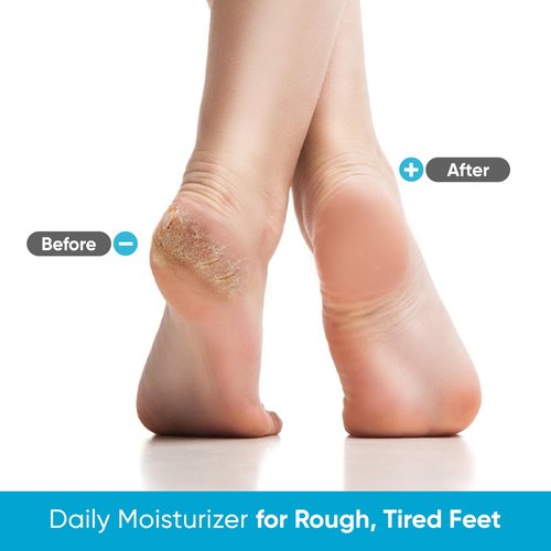 Miratiful Urea Cream 40% plus Salicylic Acid 2% (4 oz)| Urea Cream For Feet Dry Cracked Heels, Knees, Elbows, Hands Callus&Corn Treatment | Urea Foot Cream 40 Percent w/Tea Tree & Coconut Oil