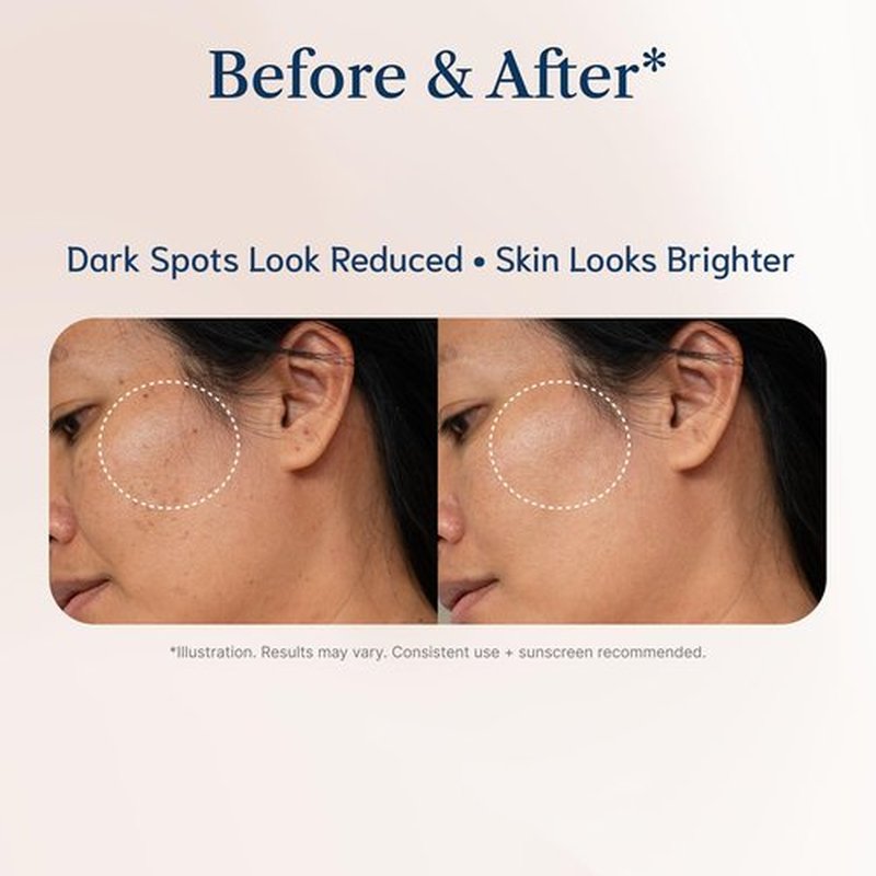 Dark Spot Remover for Face –Tranexamic Acid Serum with Niacinamide & Vitamin C, Dark Spot Corrector, Hyperpigmentation Care 30ml / 1 fl oz