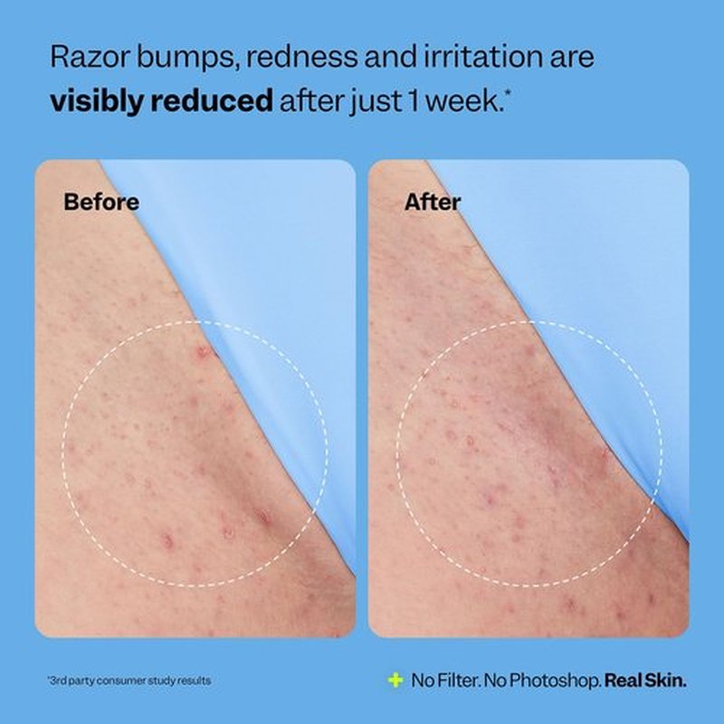 Peach Slices Ingrown Hair Treatment - Smoothing Solution with 360 Roller (1.69 oz) | Vegan & Cruelty-Free