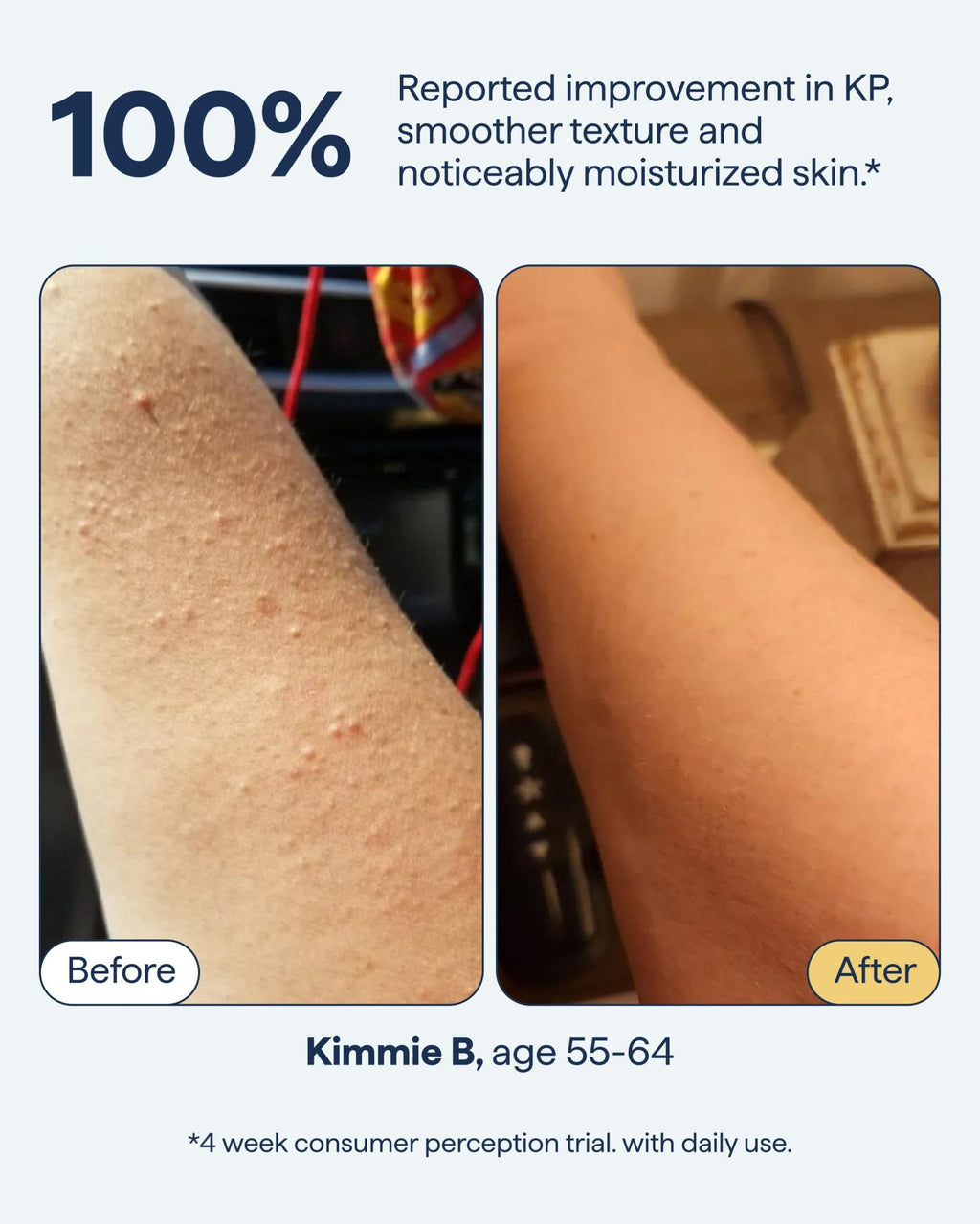 Remedy for Body Bumps | KP Exfoliating Body Moisturizer | Keratosis Pilaris (KP) Treatment For Textured, Crepey Skin with Urea, Lactic Acid, Retinol | Smoothing Body Lotion | By Dermatologist Dr. Shah